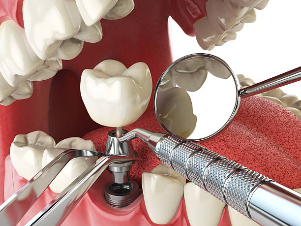 Best Knocked-Out Tooth (Avulsed Tooth) Treatment in Hudson, CO